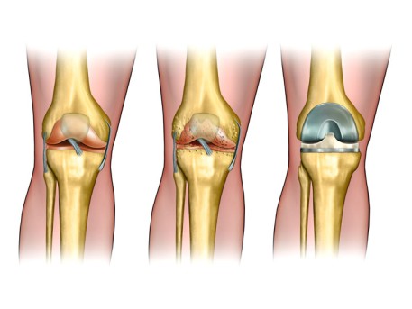 Knee Replacement Surgery by OrangeCountySurgeons